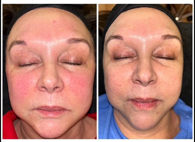 Face before and after